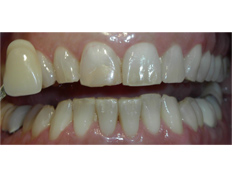 Zoom whitening treatment