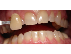 Zoom whitening treatment